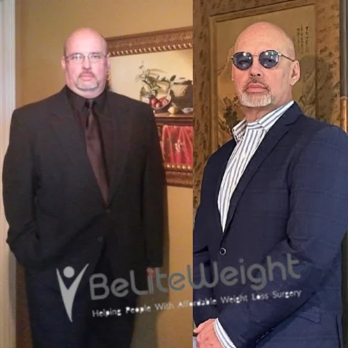 Weight Loss Surgery Gastric Sleeve before and after